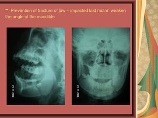 - Prevention of fracture of jaw – impacted last molar weaken
the angle of the mandible
 