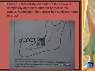Class 1 - Mesiodistal diameter of the crown is
completely anterior to anterior border of the
ramus. Mandibular third molar has sufficient room
to erupt
 