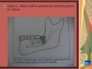 Class 2 - About half is covered by anterior portion
of ramus
 