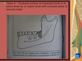 Class A - Occlusal surface of impacted tooth is at
same level as or nearly level with occlusal plane of
second molar
 
