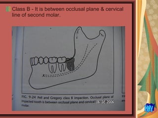 Class B - It is between occlusal plane & cervical
line of second molar.
 