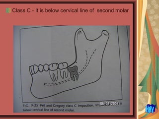 Class C - It is below cervical line of second molar
 