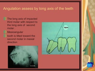 Angulation assess by long axis of the teeth
The long axis of impacted
third molar with respect to
the long axis of second
molar .
Mesioangular
tooth is tilted toward the
second molar in mesial
direction
 