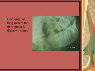 Distoangular ;
long axis of the
third molar is
distally inclined
 