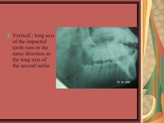 Vertical ; long axis
of the impacted
tooth runs in the
same direction as
the long axis of
the second molar
 