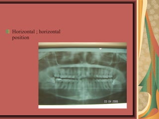 Horizontal ; horizontal
position
 