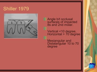 Shiller 1979
Angle b/t occlusal
surfaces of impacted
8s and 2nd molar.
Vertical <10 degree,
Horizontal > 70 degree
Mesiangular and
Distalangular 10 to 70
degree
 