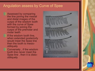 Assessed by comparing
the line joining the mesial
and distal images of the
cusps of the wisdom tooth
with the curve of Spee
formed by joining the
cusps of the premolar and
molar teeth
If the wisdom tooth line,
when extended posteriorly
would meet the Spee line
then the tooth is mesio-
obliquely
Conversely , if the wisdom
tooth line never meet the
Spee line , then it is disto-
obliquely
Angulation assess by Curve of Spee
 