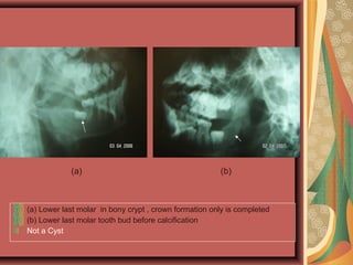 (a) Lower last molar in bony crypt , crown formation only is completed
(b) Lower last molar tooth bud before calcification
Not a Cyst
(a) (b)
 