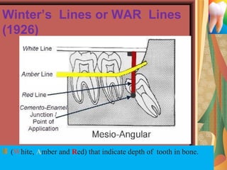 Winter’s Lines or WAR Lines
(1926)
(White, Amber and Red) that indicate depth of  tooth in bone.
 