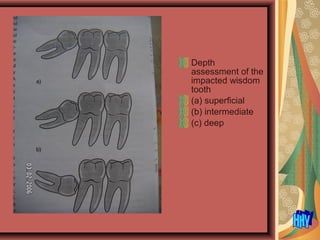 Depth
assessment of the
impacted wisdom
tooth
(a) superficial
(b) intermediate
(c) deep
 
