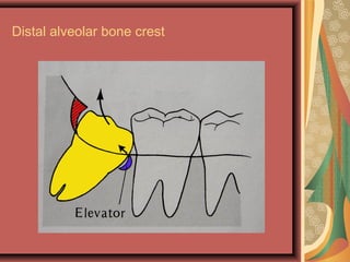 Distal alveolar bone crest
 