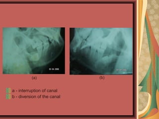 a - interruption of canal
b - diversion of the canal
(a) (b)
 