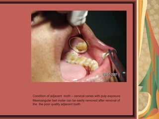 Condition of adjacent tooth – cervical caries with pulp exposure
Mesioangular last molar can be easily removed after removal of
the the poor quality adjacent tooth
 