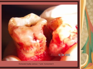 Extracted badly carious 7 and horizontal 8
 