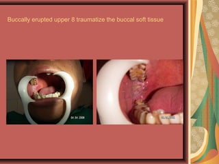 Buccally erupted upper 8 traumatize the buccal soft tissue
 