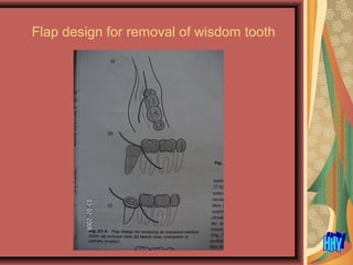 Flap design for removal of wisdom tooth
 
