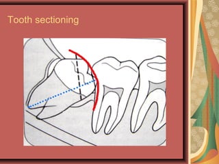 Tooth sectioning
 