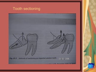 Tooth sectioning
 