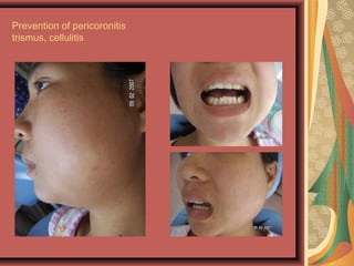 Prevention of pericoronitis
trismus, cellulitis
 