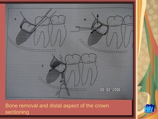 Bone removal and distal aspect of the crown
sectioning
 