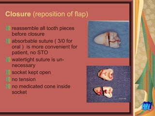 Closure (reposition of flap)
reassemble all tooth pieces
before closure
absorbable suture ( 3/0 for
oral ) is more convenient for
patient, no STO
watertight suture is un-
necessary
socket kept open
no tension
no medicated cone inside
socket
 