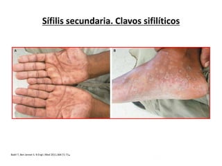 Rash Associated with Secondary Syphilis

Sífilis secundaria. Clavos sifilíticos

.

Badri T, Ben Jennet S. N Engl J Med 2011;364:71-71

 