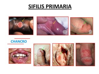 2014-02-06) Sifilis (ppt)