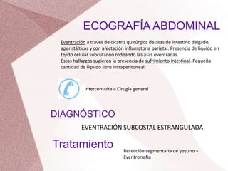 Eventración a través de cicatriz quirúrgica de asas de intestino delgado,
aperistálticas y con afectación inflamatoria parietal. Presencia de líquido en
tejido celular subcutáneo rodeando las asas eventradas.
Estos hallazgos sugieren la presencia de sufrimiento intestinal. Pequeña
cantidad de líquido libre intraperitoneal.
ECOGRAFÍA ABDOMINAL
Interconsulta a Cirugía general
DIAGNÓSTICO
EVENTRACIÓN SUBCOSTAL ESTRANGULADA
Tratamiento Resección segmentaria de yeyuno +
Eventrorrafia
 
