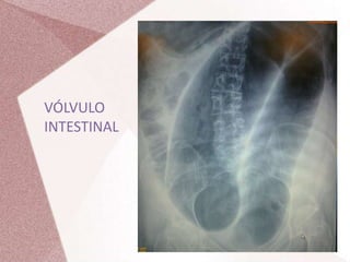 VÓLVULO
INTESTINAL
 
