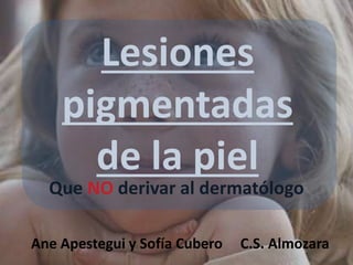 Lesiones 
pigmentadas 
de la piel 
Que NO derivar al dermatólogo 
Ane Apestegui y Sofía Cubero C.S. Almozara 
 