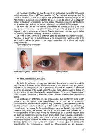 La mancha mongólica es más frecuente en según qué razas (80-90% razas 
asiáticas o negroides y 1-15% en raza blanca). Son máculas gris-pizarrosas de 
distintos tamaños, únicas o múltiples, que generalmente se observan ya en el 
nacimiento y desaparecen alrededor de los 5 años de edad. La localización 
típica es la región lumbosacra, aunque estas máculas de aspecto contusiforme 
en ocasiones se localizan en partes distantes y persisten indefinidamente. 
El nevus de Ota es una mácula circunscrita de bordes difusos y de color 
azul grisáceo en áreas de piel inervadas por la primera y/o segunda rama del 
trigémino. Generalmente es unilateral. Puede observarse máculas pigmentadas 
en mucosa oral, nasal, ocular y membrana timpánica. 
El nevus de Ito, similar a la anterior, pero de localización acromiodeltoidea. 
Aparece a partir de la adolescencia y no desaparece. Corresponde a la 
localización del nervio inervado por ramas supraclavicular y lateral del nervio 
braquiocutáneo. 
10 
Pueden tratarse con láser. 
Mancha mongólica Nevus de Ito Nevus de Ota 
3) Nevo melanocítico adquirido 
Se trata de lesiones benignas que aparecen de manera progresiva desde la 
infancia hasta la edad adulta. Posteriormente, y también de forma progresiva, 
tienden a su desaparición en la población anciana. El máximo número de 
lesiones se alcanza entre los 20 y los 29 años y es la adolescencia la época en 
en que aparecen más rápidamente nuevas lesiones. En su aparición participan 
tanto factores genéticos y familiares como factores ambientales (exposición 
solar). 
La proliferación ordenada de los melanocitos que conforman esta lesión 
empieza en las capas más superficiales de la piel, en la epidermis; 
clínicamente la lesión tiene un aspecto muy pigmentado, homogéneo, plano, de 
bordes simétricos (aunque algunos pueden mostrar cierto grado de asimetría) y 
normalmente de menos de 6 mm de diámetro (nevo de la unión o juntural). De 
manera progresiva, la lesión madura y va creciendo en profundidad e 
histológicamente se observan nidos de melanocitos en la dermis papilar. Esto 
se expresa clínicamente en una lesión pigmentada más papulosa, cupuliforme, 
homogénea y de un color más claro que en el juntural (nevo compuesto). 
Finalmente la gran mayoría de melanocitos se sitúan en capas profundas de la 
dermis, donde presentan unas dimensiones menores que en zonas más 
superficiales. En ocasiones es difícil su diferenciación de los linfocitos. 
 