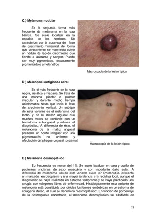 19 
C.) Melanoma nodular 
Es la segunda forma más 
frecuente de melanoma en la raza 
blanca. Se suele localizar en la 
espalda de los hombres. Se 
caracteriza por la ausencia de fase 
de crecimiento horizontal, de forma 
que clínicamente se manifiesta como 
un nódulo de rápido crecimiento que 
tiende a ulcerarse y sangrar. Puede 
ser muy pigmentado, escasamente 
pigmentado o amelanótico. 
Macroscopía de la lesión típica 
D.) Melanoma lentiginoso acral 
Es el más frecuente en la raza 
negra, asiática e hispana. Se trata de 
una mancha plantar o palmar 
irregular y durante mucho tiempo 
asintomática hasta que inicia la fase 
de crecimiento vertical. Un subtipo 
de esta variante es el melanoma del 
lecho y de la matriz ungueal que 
muchas veces se confunde con un 
hematoma subungueal y retrasa el 
diagnóstico. A diferencia de éste, el 
melanoma de la matriz ungueal 
presenta un borde irregular con una 
pigmentación no uniforme y 
afectación del pliegue ungueal proximal. 
Macroscopía de la lesión típica 
E.) Melanoma desmoplásico 
Su frecuencia es menor del 1%. Se suele localizar en cara y cuello de 
pacientes ancianos de sexo masculino y con importante daño solar. A 
diferencia del melanoma clásico esta variante suele ser amelanótica, presenta 
un marcado neurotropismo y una mayor tendencia a la recidiva local, aunque el 
diagnóstico se haya realizado en estadios tempranos y se haya practicado una 
cirugía con márgenes libres de enfermedad. Histológicamente esta variante de 
melanoma está constituida por células fusiformes embebidas en un estroma de 
colágeno denso, al cual se denomina “desmoplásico”. En función del porcentaje 
de la desmoplasia encontrada, el melanoma desmoplásico se subdivide en 
 