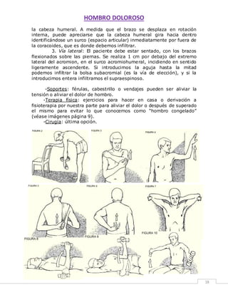 HOMBRO DOLOROSO 
18 
la cabeza humeral. A medida que el brazo se desplaza en rotación 
interna, puede apreciarse que la cabeza humeral gira hacia dentro 
identificándose un surco (espacio articular) inmediatamente por fuera de 
la coracoides, que es donde debemos infiltrar. 
3. Vía lateral: El paciente debe estar sentado, con los brazos 
flexionados sobre las piernas. Se realiza 1 cm por debajo del extremo 
lateral del acromion, en el surco acromiohumeral, incidiendo en sentido 
ligeramente ascendente. Si introducimos la aguja hasta la mitad 
podemos infiltrar la bolsa subacromial (es la vía de elección), y si la 
introducimos entera infiltramos el supraespinoso. 
-Soportes: férulas, cabestrillo o vendajes pueden ser aliviar la 
tensión o aliviar el dolor de hombro. 
-Terapia física: ejercicios para hacer en casa o derivación a 
fisioterapia por nuestra parte para aliviar el dolor o después de superado 
el mismo para evitar lo que conocemos como “hombro congelado” 
(véase imágenes página 9). 
-Cirugía: última opción. 
 