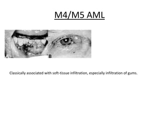 M4/M5 AML

Classically associated with soft-tissue infiltration, especially infiltration of gums.

 