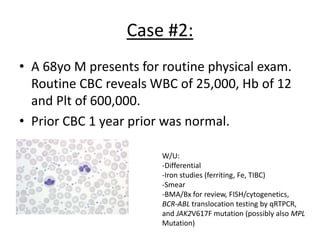 Case #2:
• A 68yo M presents for routine physical exam.
Routine CBC reveals WBC of 25,000, Hb of 12
and Plt of 600,000.
• Prior CBC 1 year prior was normal.
W/U:
-Differential
-Iron studies (ferriting, Fe, TIBC)
-Smear
-BMA/Bx for review, FISH/cytogenetics,
BCR-ABL translocation testing by qRTPCR,
and JAK2V617F mutation (possibly also MPL
Mutation)

 