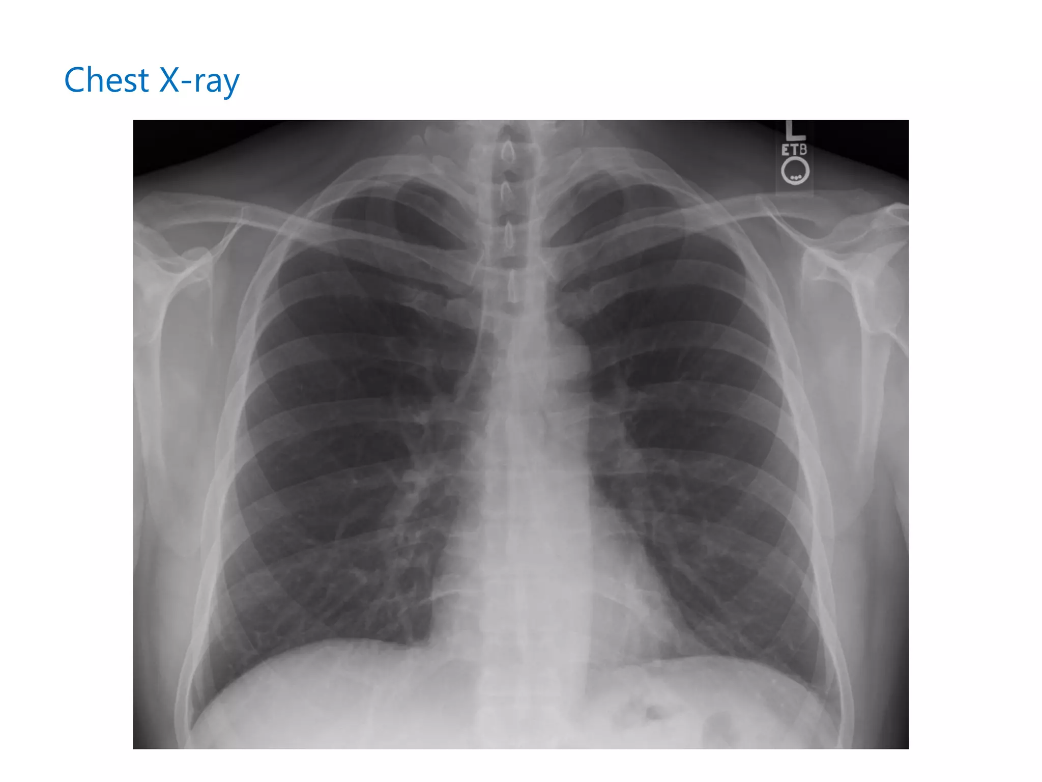 Chest X-ray
 