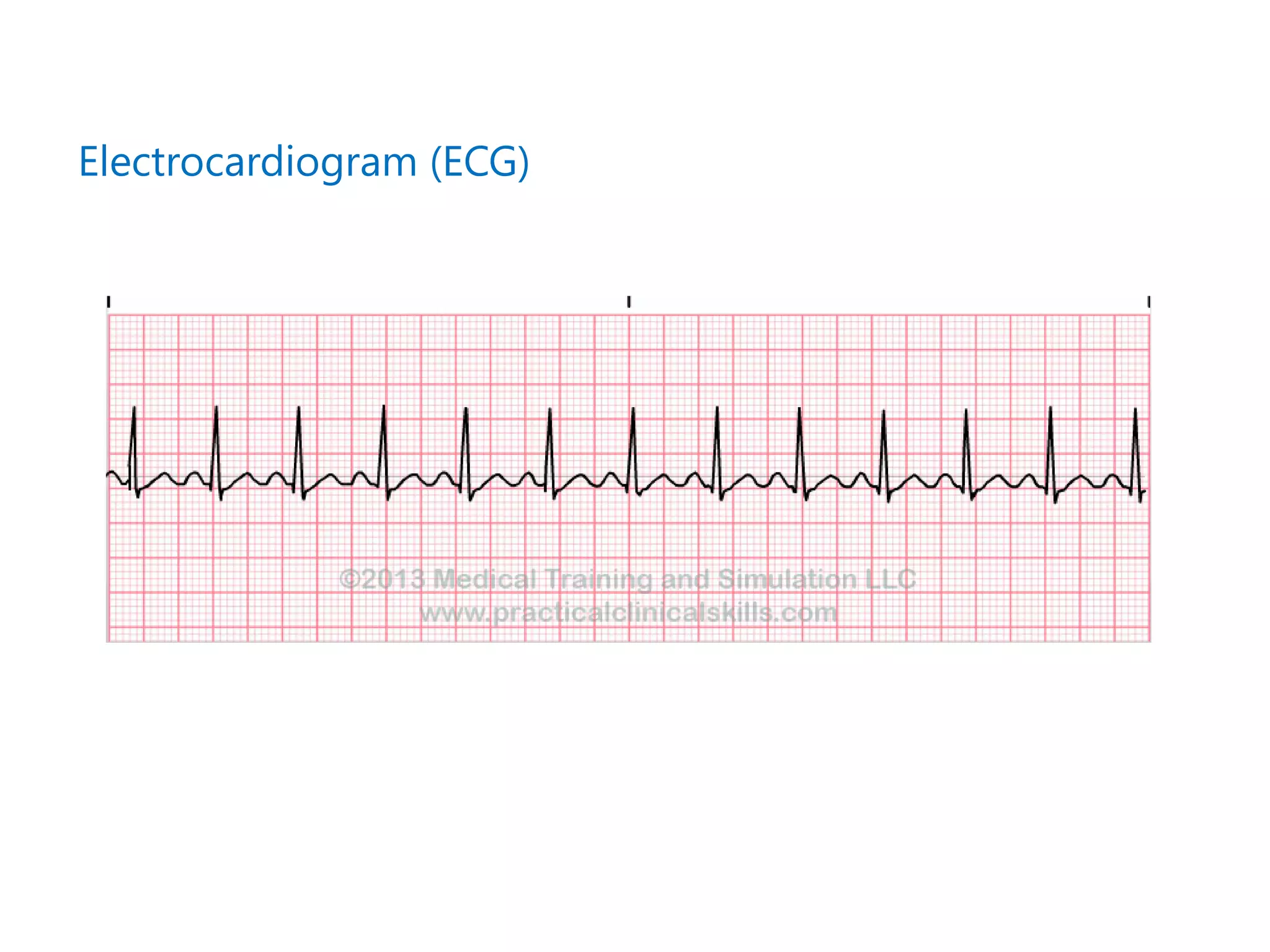 Electrocardiogram (ECG)
 