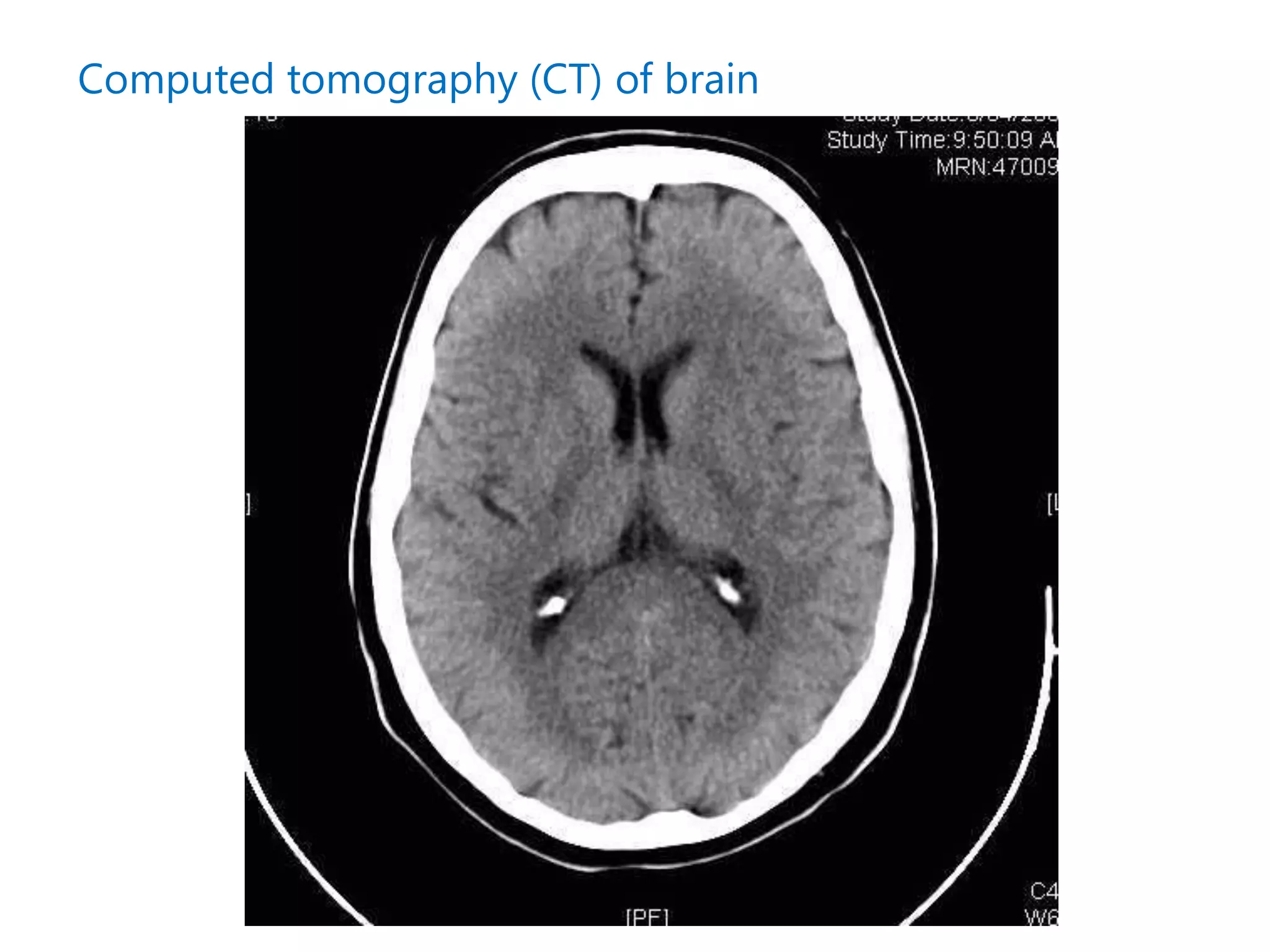 Computed tomography (CT) of brain
 