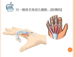 另一種發炎後退化腫脹…{扳機指}
11
 