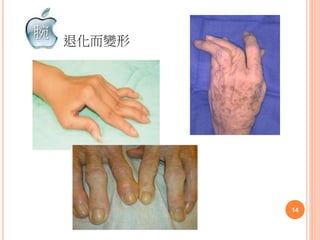 退化而變形
14
腕
 