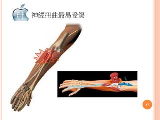 神經扭曲最易受傷肘
17
 