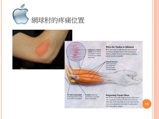 網球肘的疼痛位置
19
 