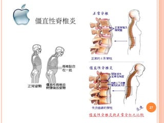僵直性脊椎炎
27
 