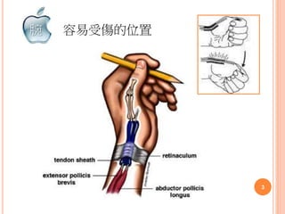 容易受傷的位置腕
3
 