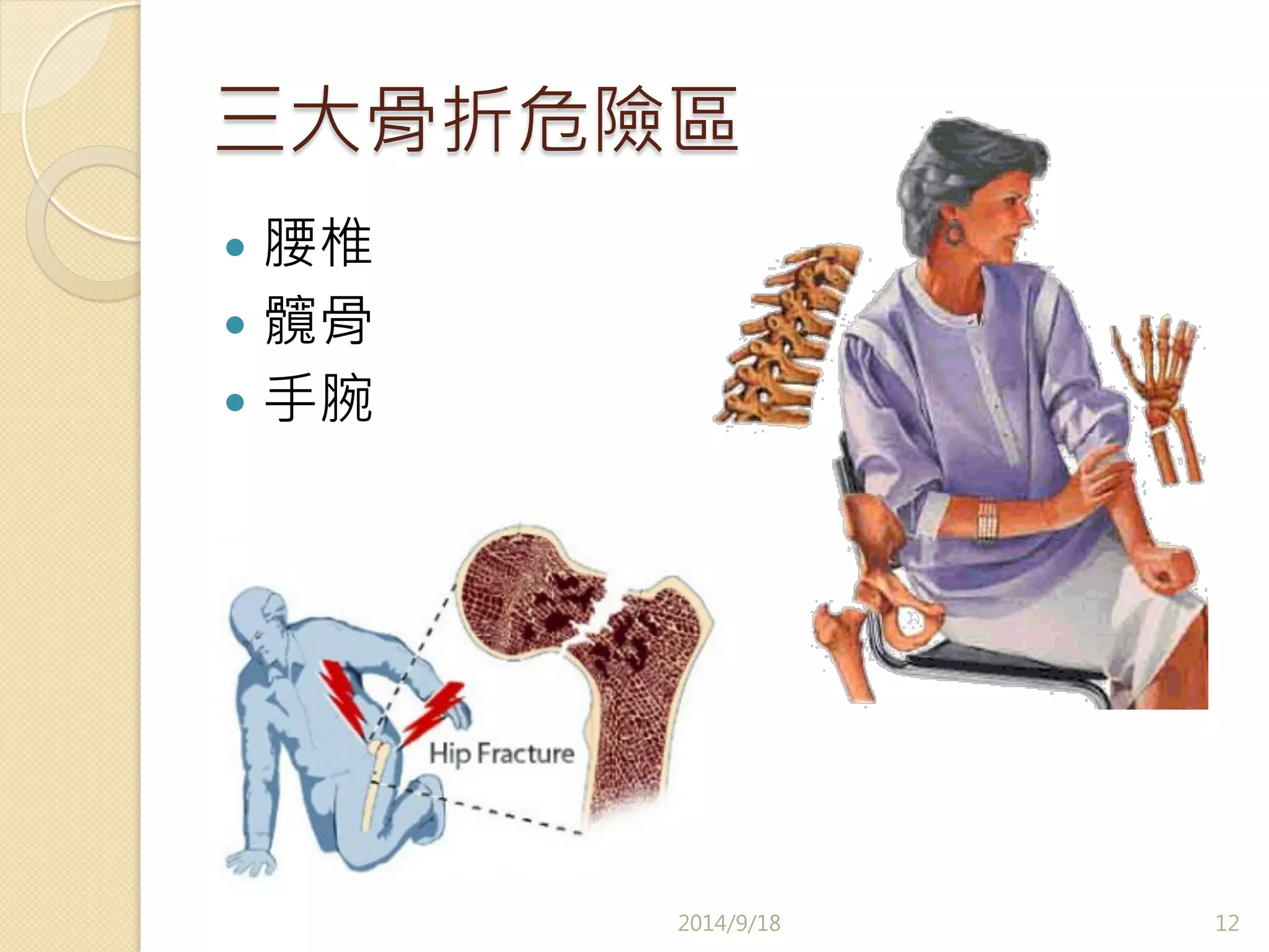 三大骨折危險區 
— 腰椎 
— 髖骨 
— 手腕 
2014/9/18 
12 
 
