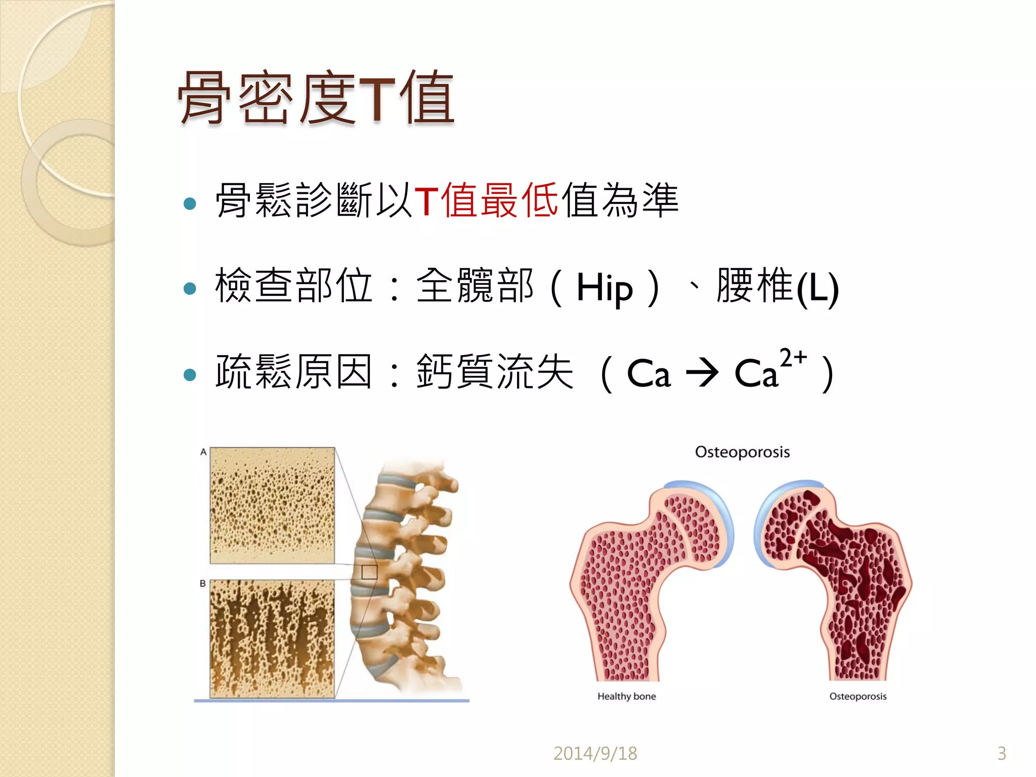 骨密度T值 
— 骨鬆診斷以T值最低值為準 
— 檢查部位：全髖部（Hip）、腰椎(L) 
— 疏鬆原因：鈣質流失 （Ca à Ca2+） 
2014/9/18 
3 
 