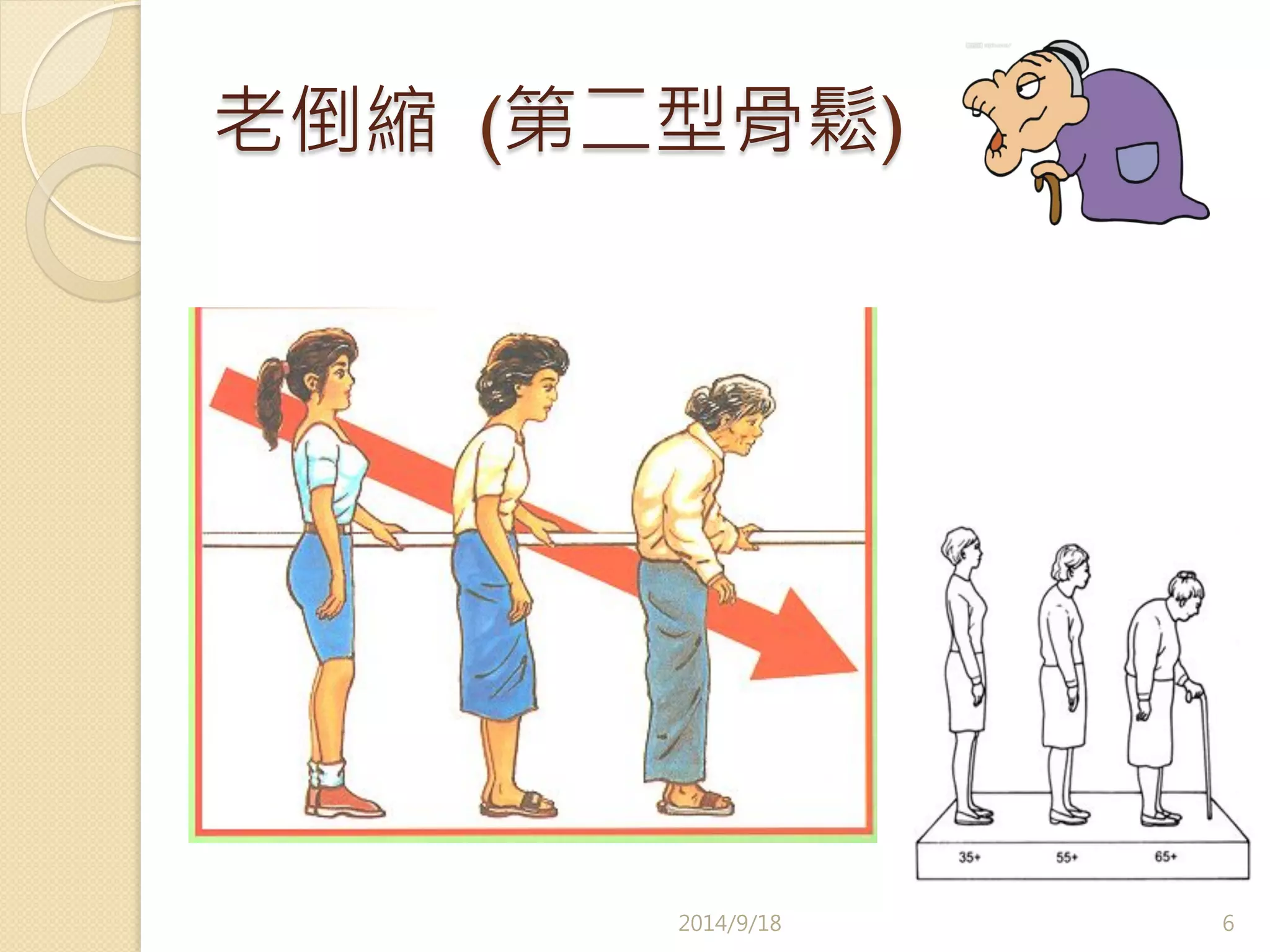 老倒縮 (第二型骨鬆) 
2014/9/18 
6 
 