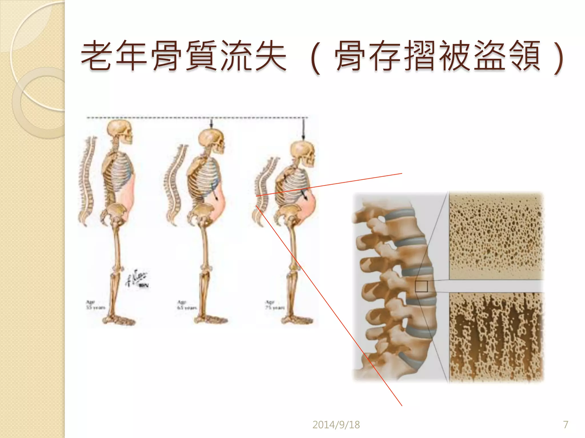 老年骨質流失 （骨存摺被盜領） 
2014/9/18 
7 
 
