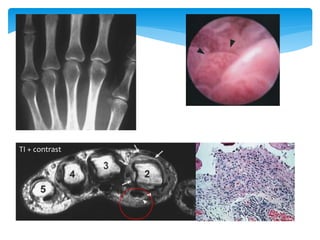 MRI and Miniarthroscopy of MCP Joints in RA . Arthritis Rheum 2001; 44:2492–2502.
TI + contrast
 